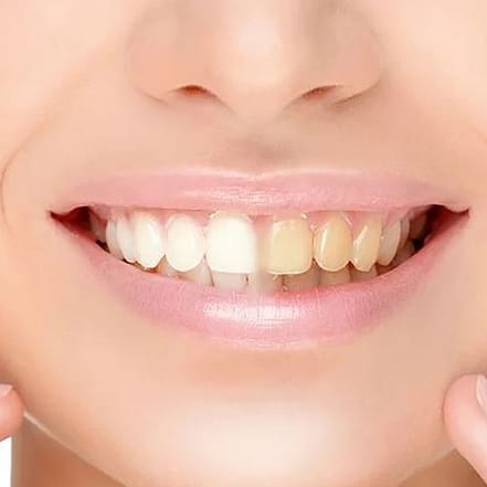 30 Min. kosmetisches Zahn-Bleaching inkl. Beratung für 1 Person Essen OXGE.com Special Offers, Deals & Discounts in Germany