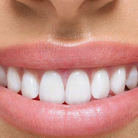 Kosmetisches Zahn-Bleaching Frankfurt OXGE.com Special Offers, Deals & Discounts in Germany