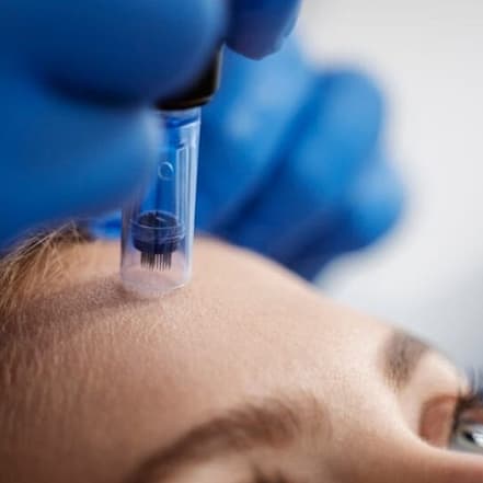 Micro-Needling Wiesbaden OXGE.com Special Offers, Deals & Discounts in Germany