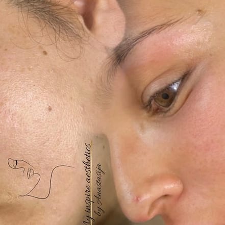 Microneedling oder BB Glow inkl. Abreinigung für 1 Person Düsseldorf OXGE.com Special Offers, Deals & Discounts in Germany