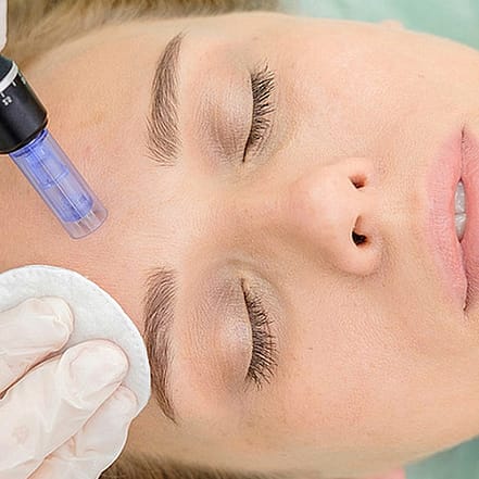 Micro-Needling Dresden OXGE.com Special Offers, Deals & Discounts in Germany