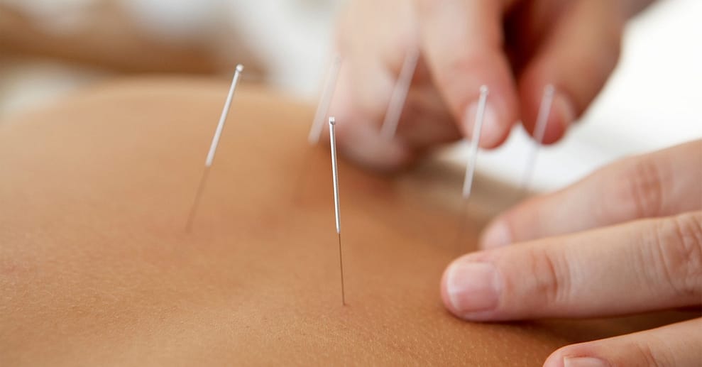 Akupunktur zum Thema nach Wahl Bielefeld OXGE.com Special Offers, Deals & Discounts in Germany