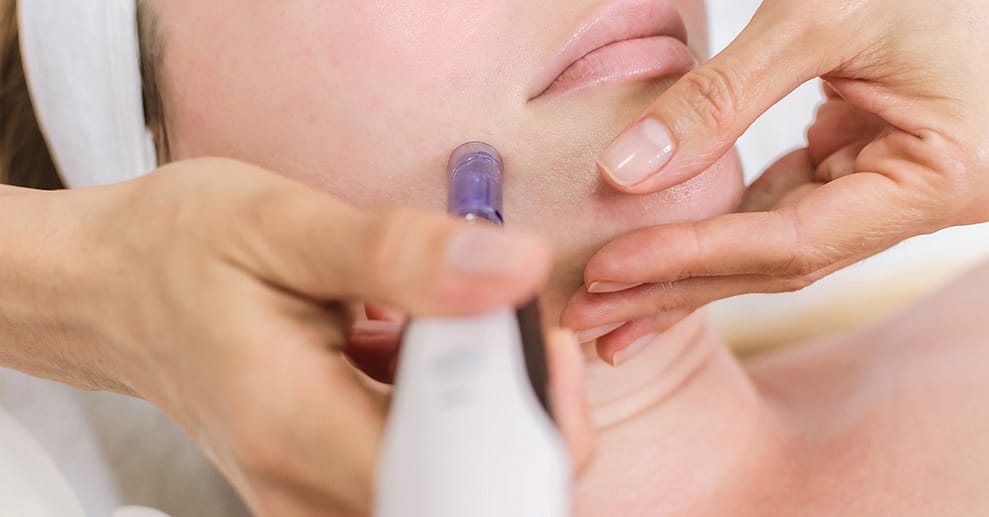 Microneedling inkl. Hyaluron oder Anti-Mitesser-Paket für 1 Person Düsseldorf OXGE.com Special Offers, Deals & Discounts in Germany