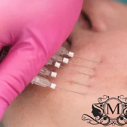 Fadenlifting-Behandlung Augsburg OXGE.com Special Offers, Deals & Discounts in Germany