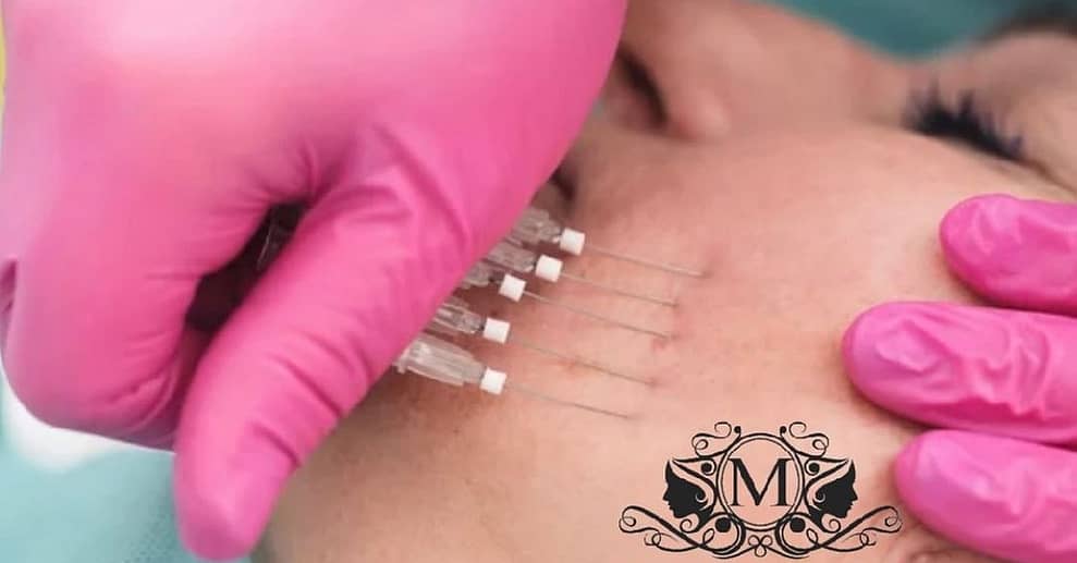 Fadenlifting-Behandlung Augsburg OXGE.com Special Offers, Deals & Discounts in Germany