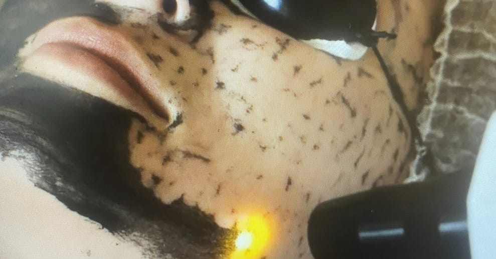 60 Min. Carbon-Laser-Peeling mit Hyaluron- & Intensivpflege-Ampulle Köln OXGE.com Special Offers, Deals & Discounts in Germany