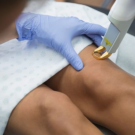 Laser-Behandlung von Besenreisern Wiesbaden OXGE.com Special Offers, Deals & Discounts in Germany