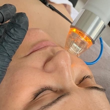 1 oder 2x 60 Min. Radiofrequenz-Microneedling inkl. Seren für 1 Person Stuttgart OXGE.com Special Offers, Deals & Discounts in Germany