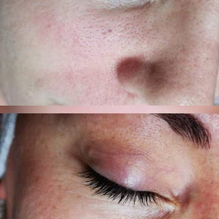 Permanent Make-up Entfernung Berlin OXGE.com Special Offers, Deals & Discounts in Germany 2