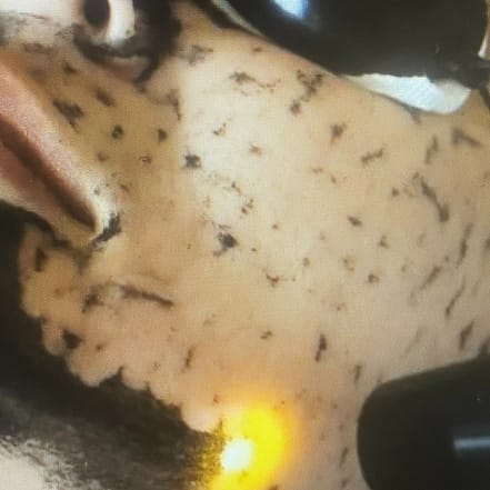 60 Min. Carbon-Laser-Peeling mit Hyaluron- & Intensivpflege-Ampulle Köln OXGE.com Special Offers, Deals & Discounts in Germany
