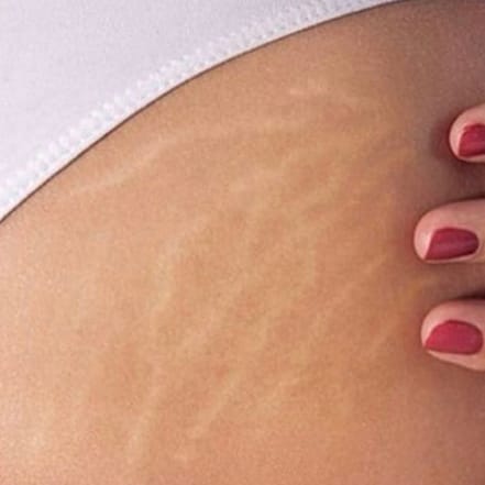 Bye Bye Cellulite! Entdecke den Weg zu glatter Haut Berlin OXGE.com Special Offers, Deals & Discounts in Germany