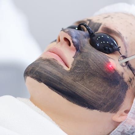 Carbon-Laser-Peeling inkl. Getränk München OXGE.com Special Offers, Deals & Discounts in Germany