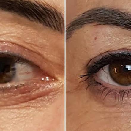 Faltenbehandlung mit dem Plasma-Pen bei Heilpraktikerin Angelika Weber München OXGE.com Special Offers, Deals & Discounts in Germany