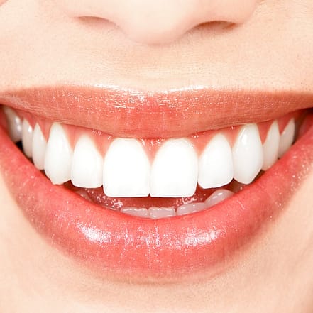 Kosmetisches Zahn-Bleaching Essen OXGE.com Special Offers, Deals & Discounts in Germany