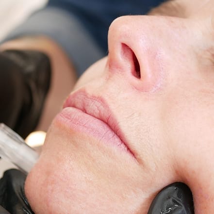 Micro-Needling München OXGE.com Special Offers, Deals & Discounts in Germany