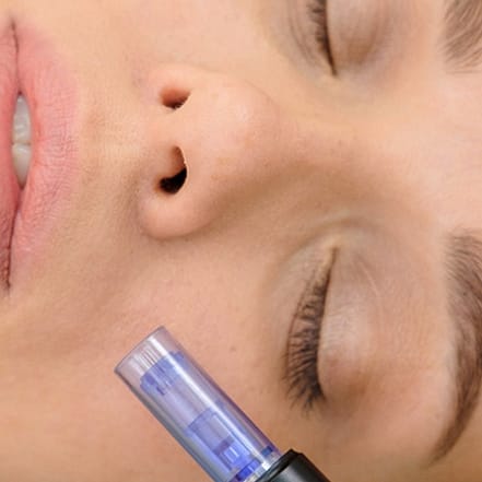 Micro-Needling Nürnberg OXGE.com Special Offers, Deals & Discounts in Germany