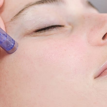 Microneedling opt. + Tiefenreinigung der Poren & Hydrogen-Behandlung Frankfurt OXGE.com Special Offers, Deals & Discounts in Germany