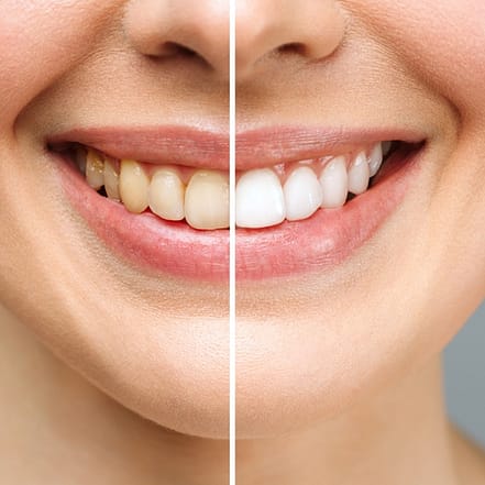 Strahlendes Lächeln erzielen mit einem kosmetischen Zahnbleaching München OXGE.com Special Offers, Deals & Discounts in Germany