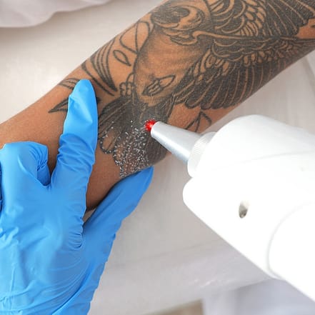 Wertgutschein anrechenbar auf Tattoo-Entfernung Bielefeld OXGE.com Special Offers, Deals & Discounts in Germany