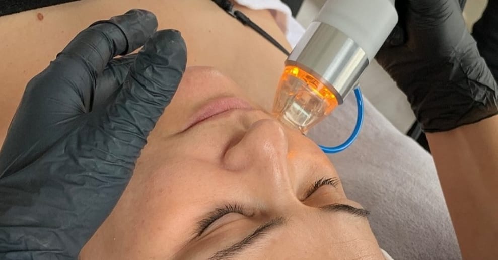 1 oder 2x 60 Min. Radiofrequenz-Microneedling inkl. Seren für 1 Person Stuttgart OXGE.com Special Offers, Deals & Discounts in Germany