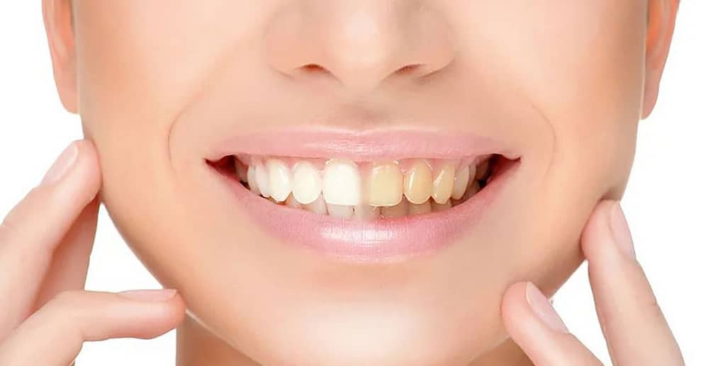 30 Min. kosmetisches Zahn-Bleaching inkl. Beratung für 1 Person Essen OXGE.com Special Offers, Deals & Discounts in Germany