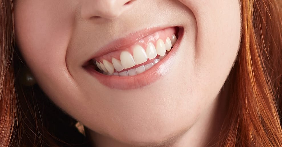 60 Min. kosmetisches Zahn-Bleaching Essen OXGE.com Special Offers, Deals & Discounts in Germany