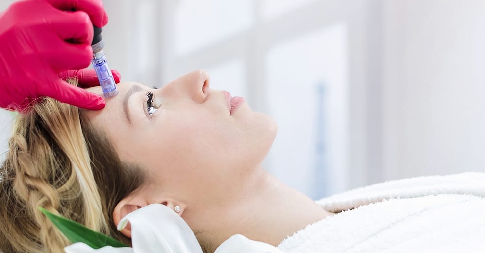 Bis zu 50% Rabatt auf den Micro-Needling bei Seyma|||Calik Köln OXGE.com Special Offers, Deals & Discounts in Germany