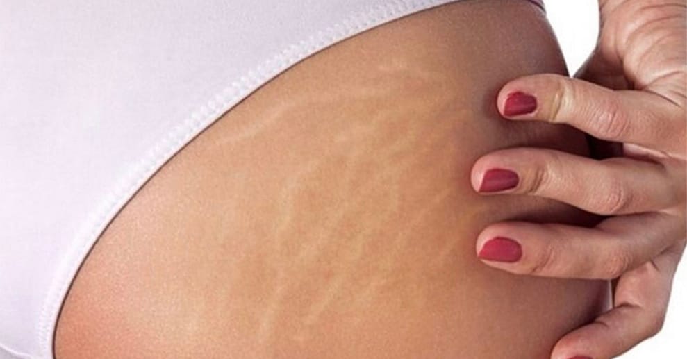 Bye Bye Cellulite! Entdecke den Weg zu glatter Haut Berlin OXGE.com Special Offers, Deals & Discounts in Germany