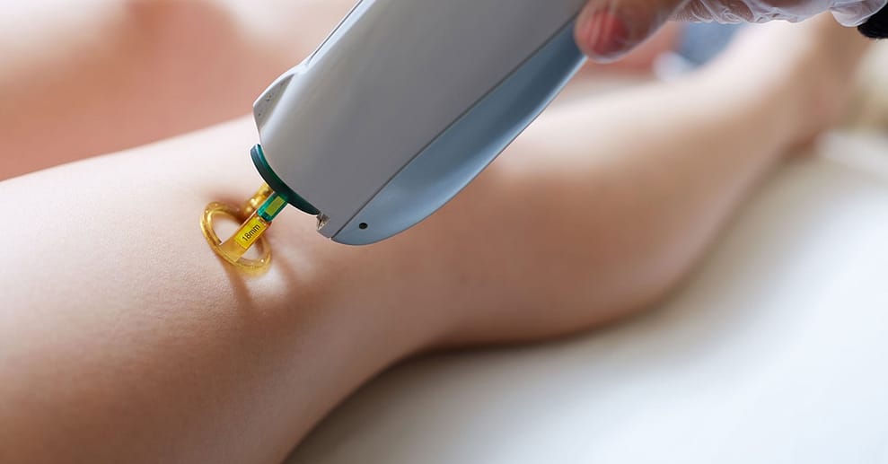 Diodenlaser-Behandlung für verschiedene Körperzonen Köln OXGE.com Special Offers, Deals & Discounts in Germany