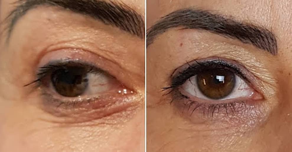 Faltenbehandlung mit dem Plasma-Pen bei Heilpraktikerin Angelika Weber München OXGE.com Special Offers, Deals & Discounts in Germany