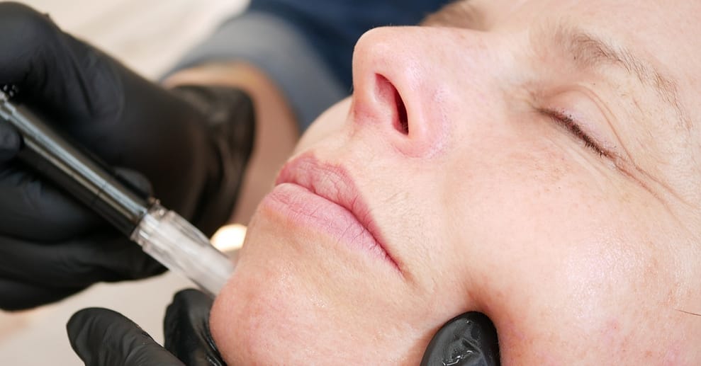 Micro-Needling München OXGE.com Special Offers, Deals & Discounts in Germany