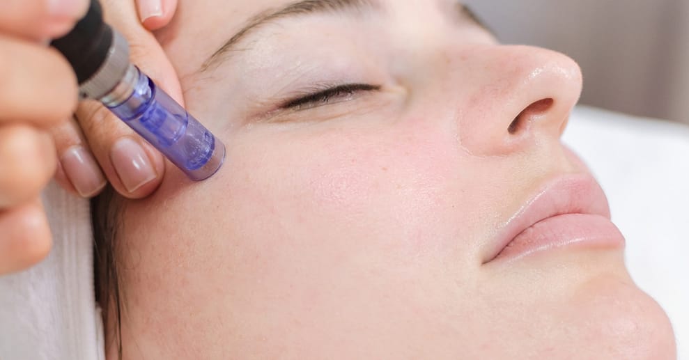 Microneedling opt. + Tiefenreinigung der Poren & Hydrogen-Behandlung Frankfurt OXGE.com Special Offers, Deals & Discounts in Germany