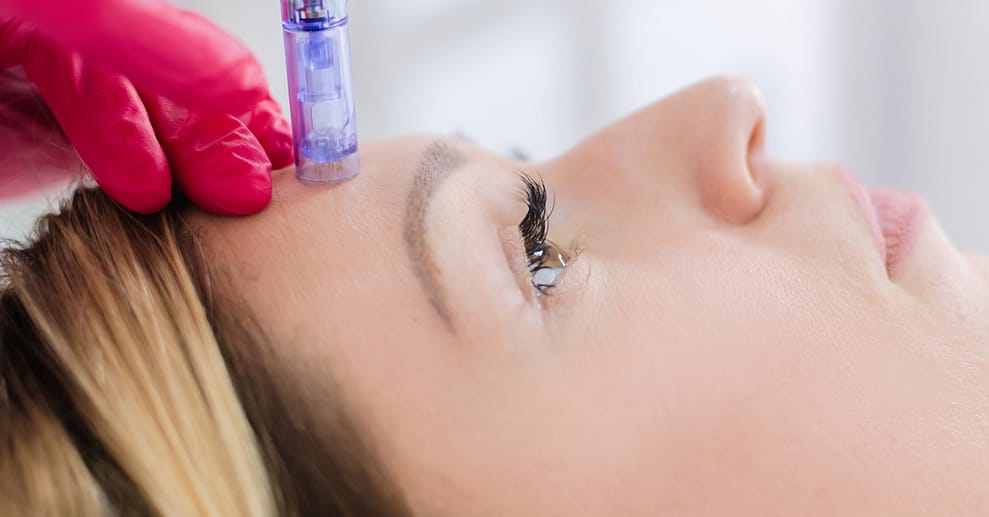 Microneedling und Diamant-Mikrodermabrasion für Gesicht für 1 Person Leipzig/Halle OXGE.com Special Offers, Deals & Discounts in Germany