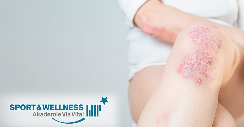Online-Kurs „Schuppenflechte (Psoriasis)“ National Deal OXGE.com Special Offers, Deals & Discounts in Germany