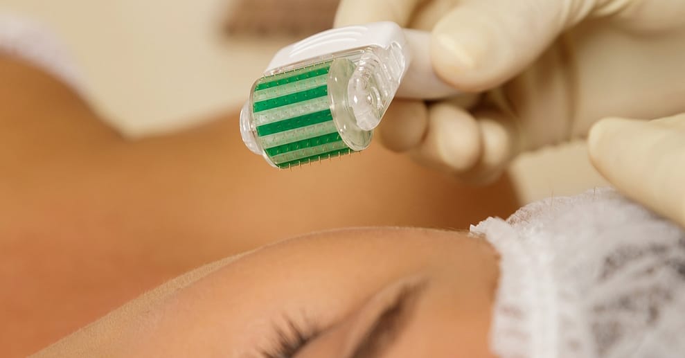 Wertgutschein Bio-Microneedling bei H M Biovital Hannover OXGE.com Special Offers, Deals & Discounts in Germany