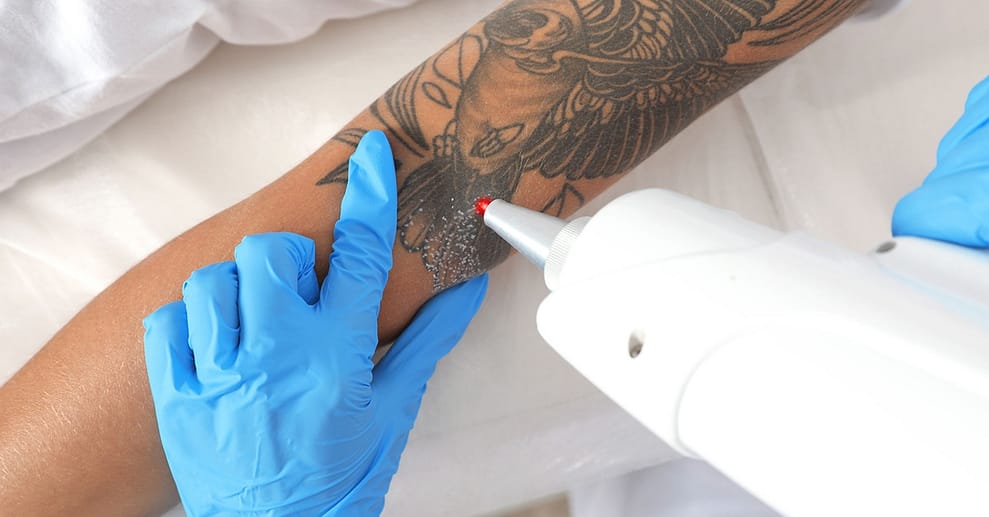 Wertgutschein anrechenbar auf Tattoo-Entfernung Bielefeld OXGE.com Special Offers, Deals & Discounts in Germany